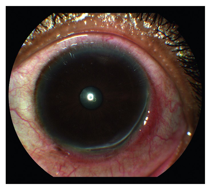 Peripheral ulcerative keratitis: eye with a peripheral corneal ulcer extending along the limbus with adjacent conjunctival injection