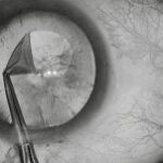 Phacoemulsification: intraoperative view during continuous curvilinear capsulorhexis