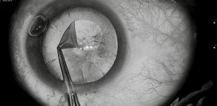 Phacoemulsification: The Small Incision That Changed Cataract Surgery