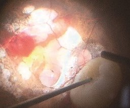 Phacoemulsification: intraoperative view of lens nucleus fragments and surgical instruments