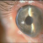 Pellucid Marginal Degeneration
