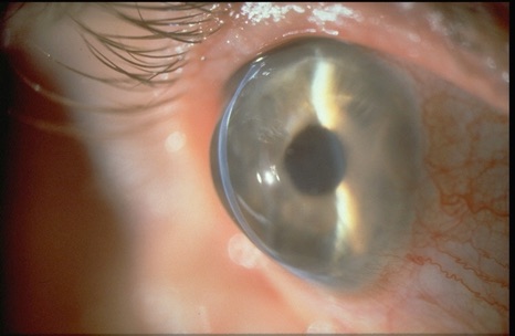 Pellucid Marginal Degeneration