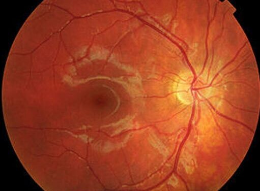 Photodynamic Therapy With Verteporfin: Where It Still Earns a Place in the Retina Clinic