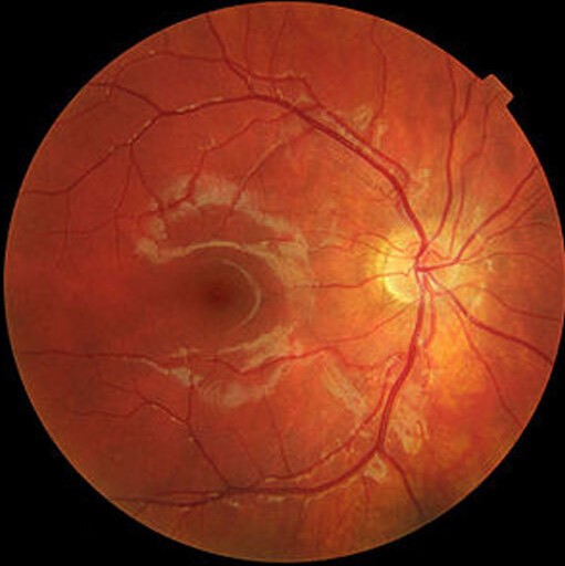 Photodynamic Therapy With Verteporfin: Where It Still Earns a Place in the Retina Clinic