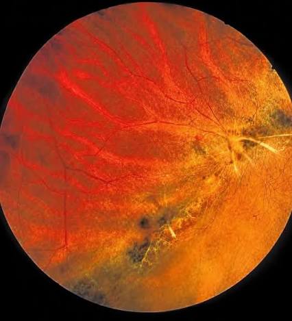 Photodynamic Therapy Verteporfin: clinical photograph, second view