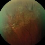 Photopsia Differential Approach: clinical photograph