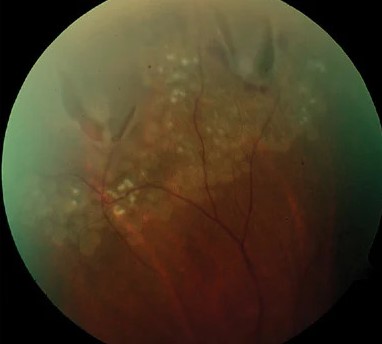 Photopsia Differential Approach Clinical Photograph 1 Photopsia Differential Approach: clinical photograph