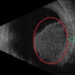 Plaque Brachytherapy Choroidal Melanoma: clinical photograph