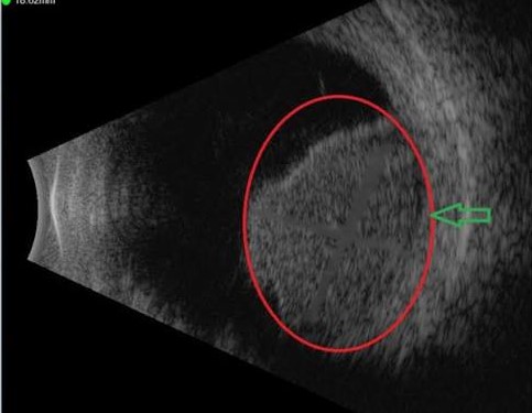 Plaque Brachytherapy for Choroidal Melanoma: What It Achieves and What It Costs the Eye