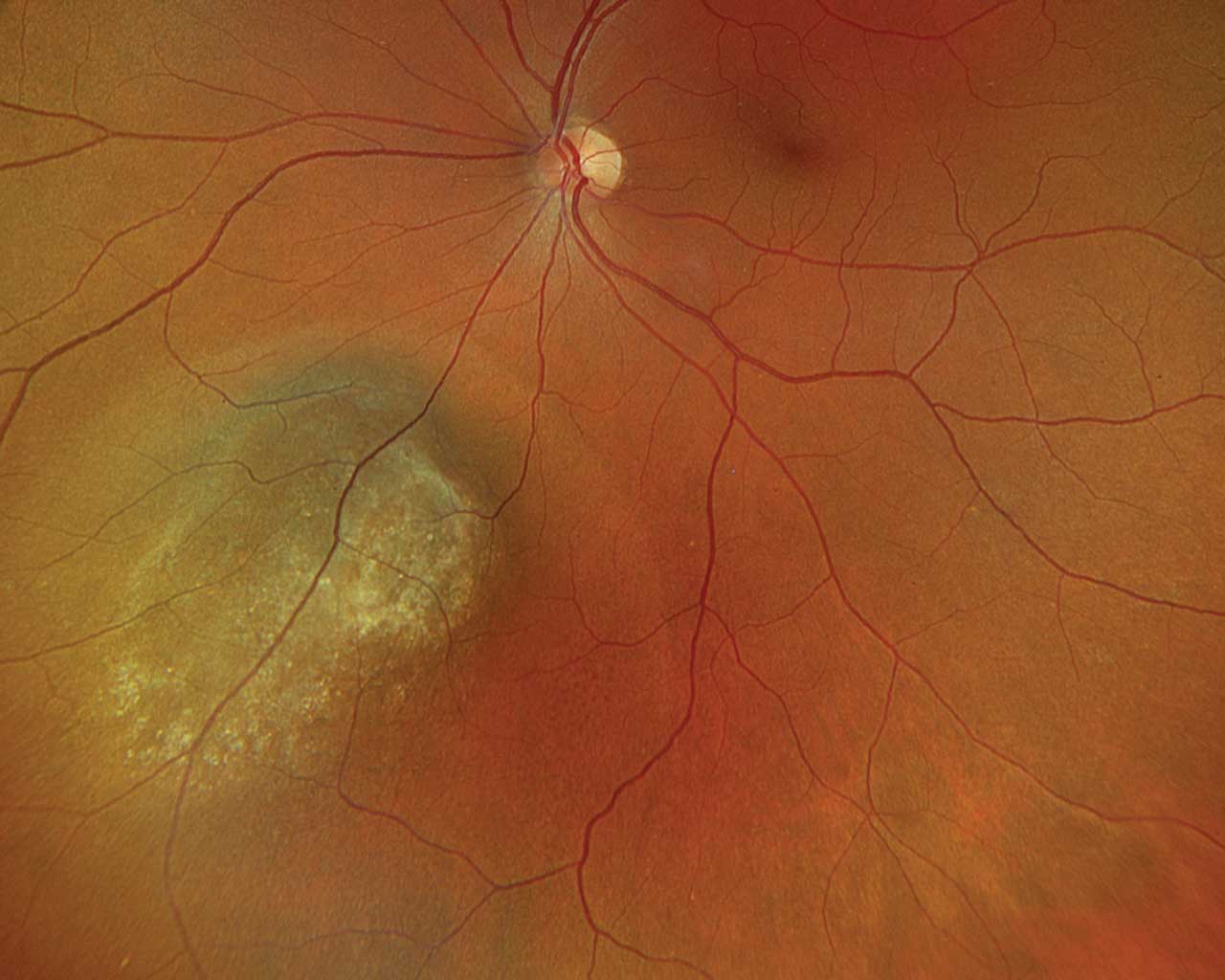 Plaque Brachytherapy Choroidal Melanoma: clinical photograph, second view