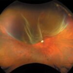 Pneumatic Retinopexy: clinical photograph