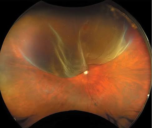Pneumatic Retinopexy: Fixing a Detachment With a Bubble and Positioning