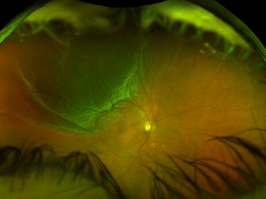 Pneumatic Retinopexy: clinical photograph, second view