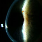 Post Lasik Ectasia: slit-lamp photograph