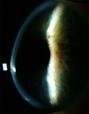Post-LASIK Ectasia: The Complication Screening Was Built to Prevent