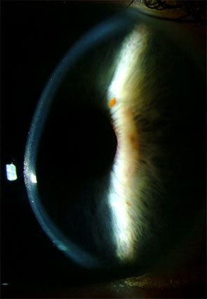 Post-LASIK Ectasia: The Complication Screening Was Built to Prevent
