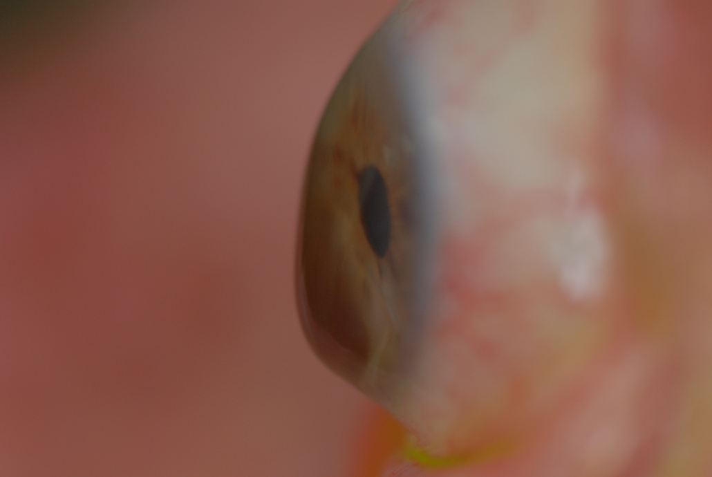 Post Lasik Ectasia: clinical photograph, second view