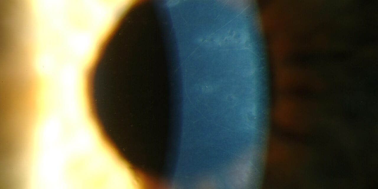 Posterior Polymorphous Corneal Dystrophy: Endothelium Acting Like Epithelium