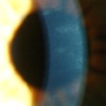 Posterior Polymorphous Corneal Dystrophy: clinical photograph