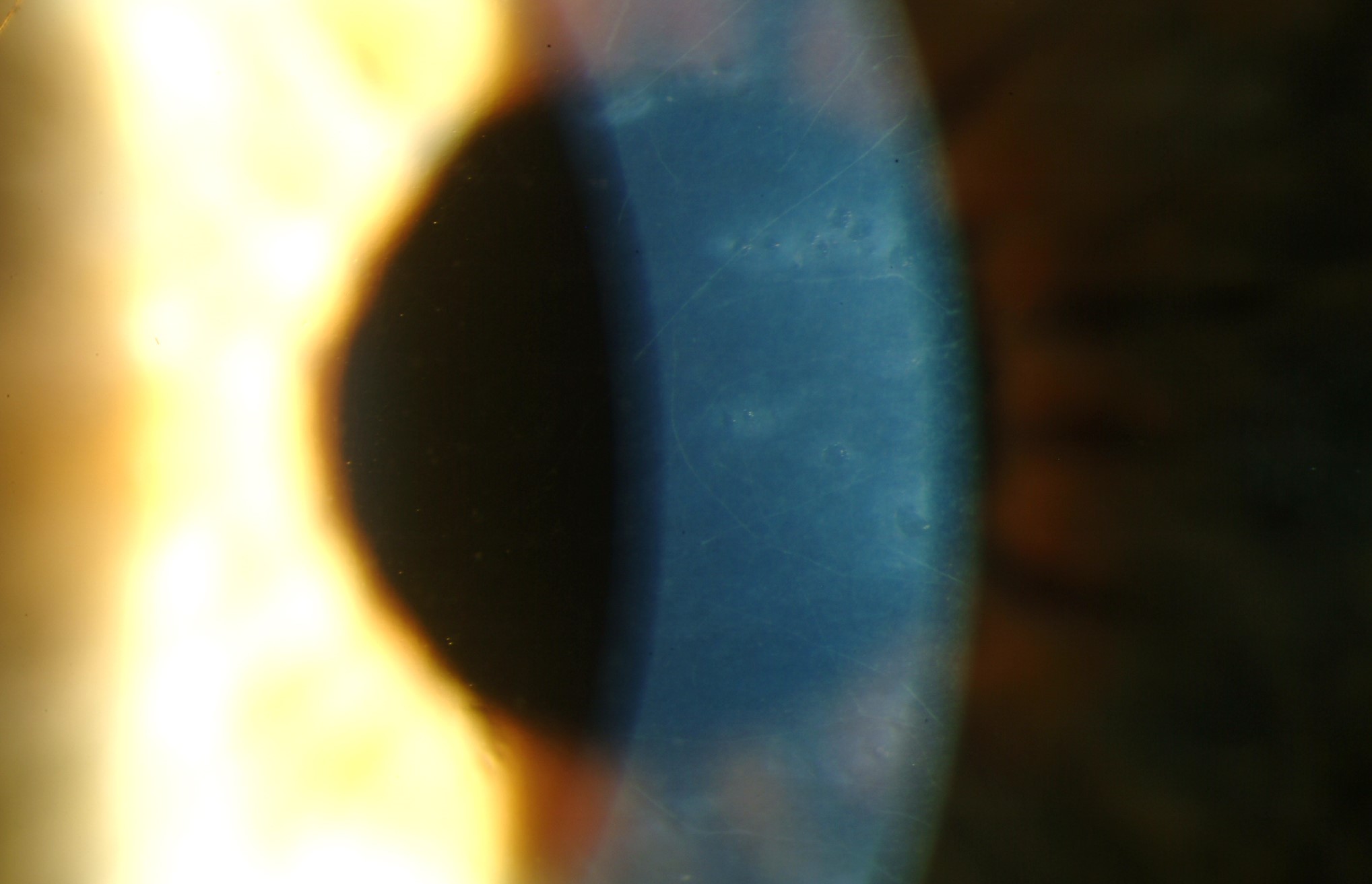 Posterior Polymorphous Corneal Dystrophy Clinical Photograph 1 Posterior Polymorphous Corneal Dystrophy: clinical photograph