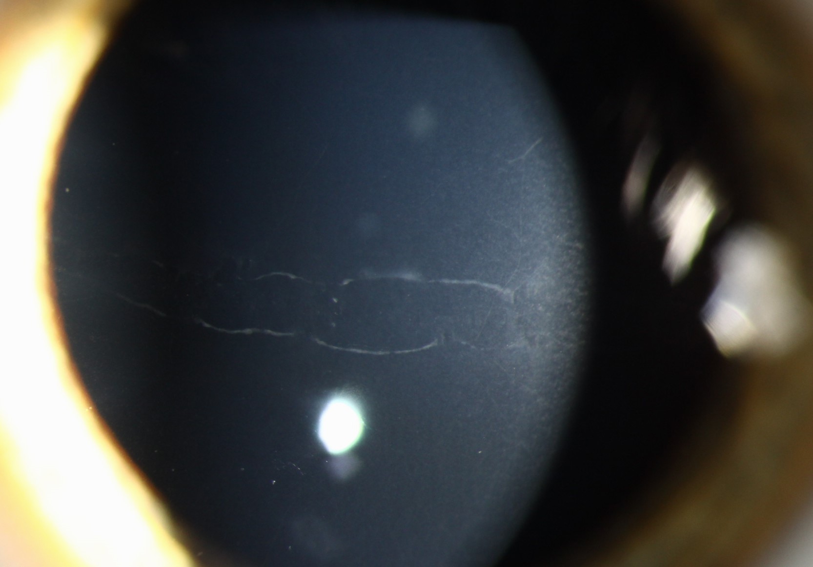 Posterior Polymorphous Corneal Dystrophy Clinical Photograph 2 Posterior Polymorphous Corneal Dystrophy: clinical photograph, second view