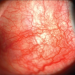 Clinical eye photograph illustrating Posterior Scleritis Imaging Diagnosis