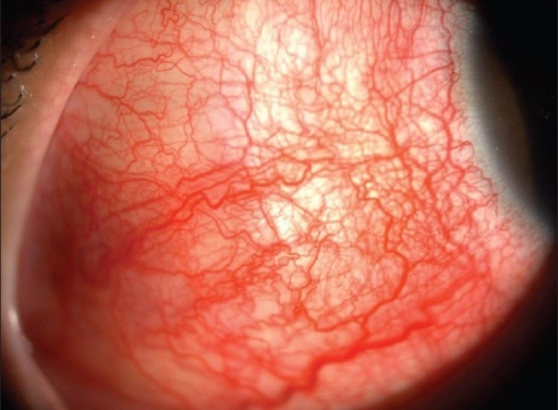 Posterior Scleritis: Imaging the Pain That the External Eye Does Not Explain