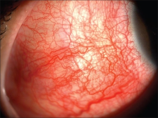 Clinical eye photograph illustrating Posterior Scleritis Imaging Diagnosis