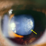 Posterior subcapsular cataract: slit-lamp photograph showing a rosette-shaped opacity beneath the posterior lens capsule (arrow)