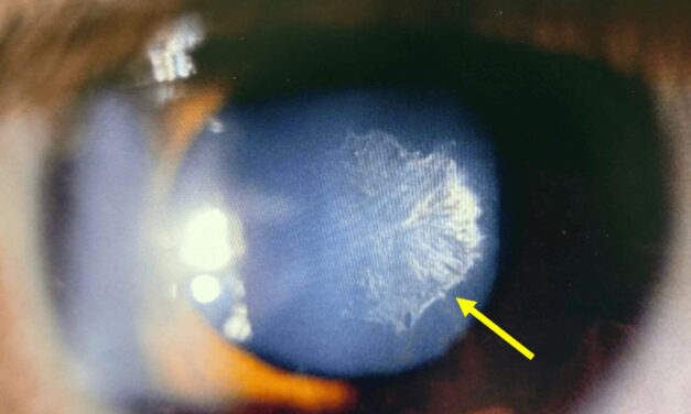 Posterior Subcapsular Cataract: Small Opacity, Big Symptoms