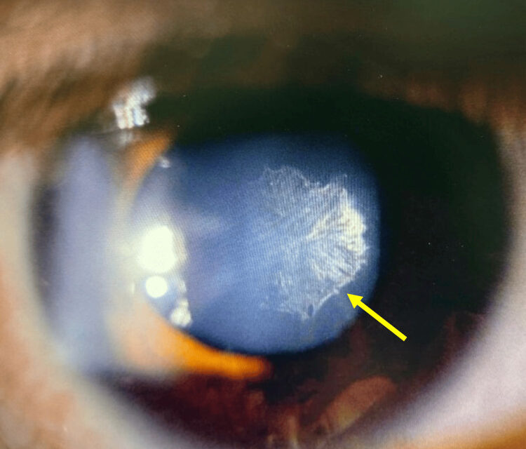Posterior Subcapsular Cataract: Small Opacity, Big Symptoms
