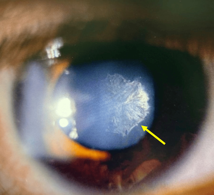 Posterior subcapsular cataract: slit-lamp photograph showing a rosette-shaped opacity beneath the posterior lens capsule (arrow)