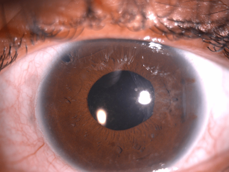 Posterior synechiae: slit-lamp photograph of the anterior segment showing subtle posterior synechiae at the pupil margin