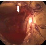 Premacular subhyaloid hemorrhage: color fundus photograph showing a large subhyaloid hemorrhage (arrow) and a Roth spot (arrowhead)
