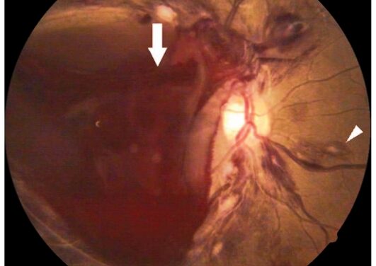 Premacular Subhyaloid Hemorrhage: Observe, or Drain With Nd:YAG Hyaloidotomy?