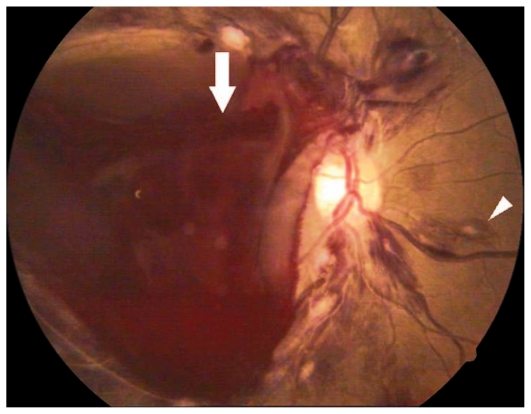 Premacular Subhyaloid Hemorrhage: Observe, or Drain With Nd:YAG Hyaloidotomy?
