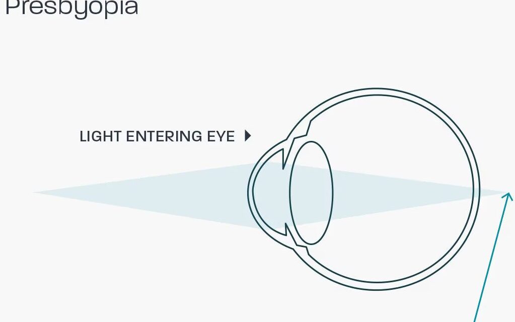 Presbyopia: Why Every Eye Eventually Needs Help Up Close