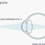 Presbyopia: clinical photograph