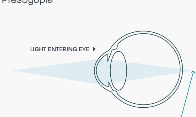 Presbyopia: Why Every Eye Eventually Needs Help Up Close