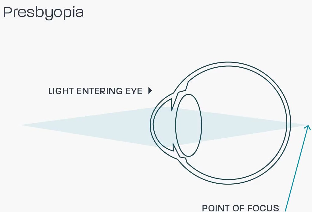 Presbyopia Clinical Photograph 1 Presbyopia: clinical photograph