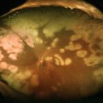 Progressive Outer Retinal Necrosis: clinical photograph