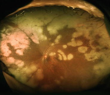 Progressive Outer Retinal Necrosis: The Necrotizing Retinitis With Almost No Inflammation