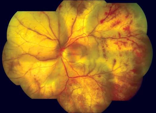 Progressive Outer Retinal Necrosis: clinical photograph, second view