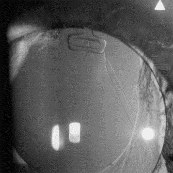 Pseudophakic Retinal Detachment: Small Breaks, Poor View and Higher Stakes