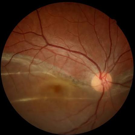 Pseudophakic Retinal Detachment: clinical photograph, second view