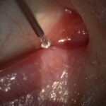 Punctal Plugs: clinical photograph