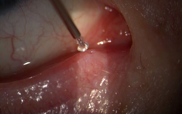 Punctal Plugs: Conserving Tears Instead of Replacing Them