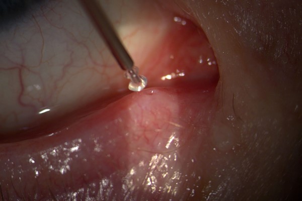 Punctal Plugs: Conserving Tears Instead of Replacing Them
