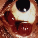 Clinical eye photograph illustrating Pyogenic Granuloma Conjunctiva Management