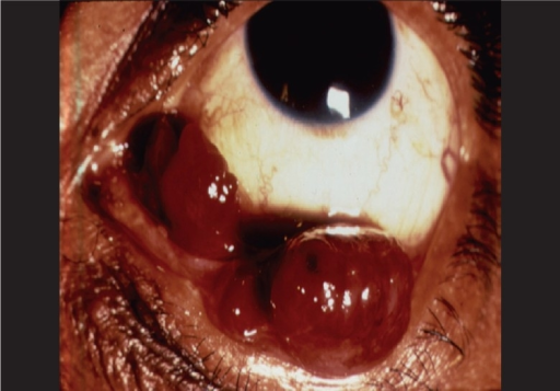 Pyogenic Granuloma of the Conjunctiva: A Fast-Growing Response to Ordinary Healing